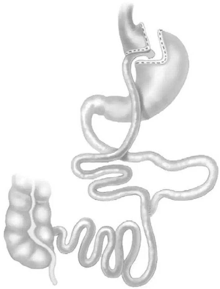 Ch17-Fig2-roux-en-Y-gastric-bypass