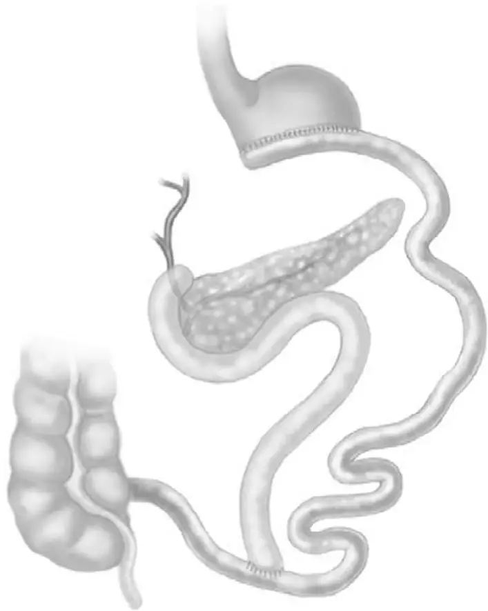 Ch17-Fig3-biliopancreatic-diversion-with-duodenal-switch
