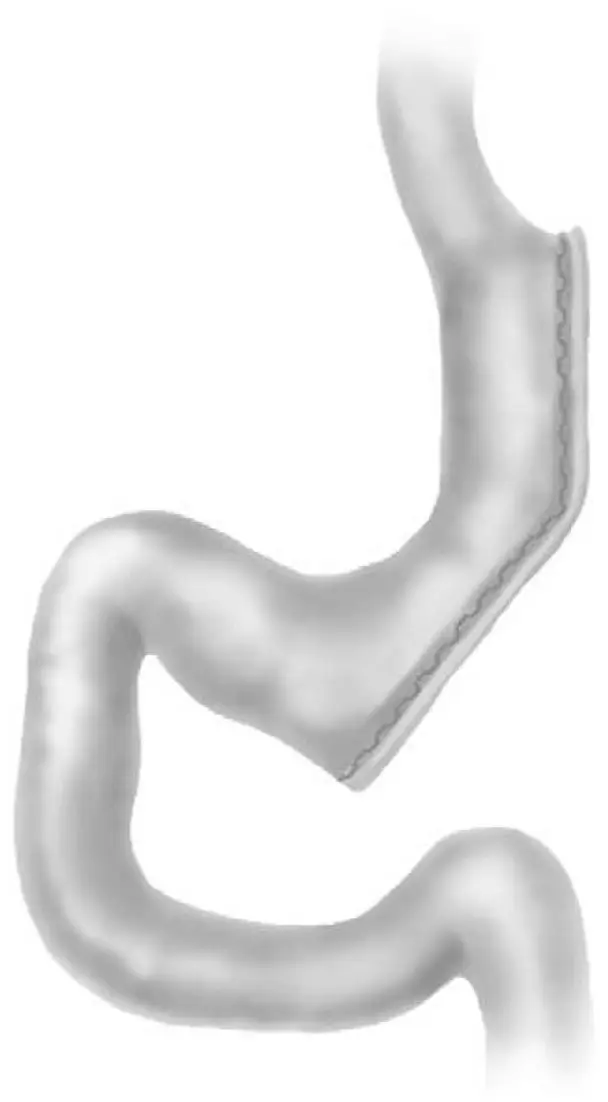 Ch17-Fig1-gastric-sleeve
